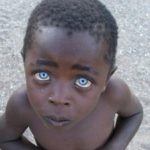 ocular-albinism